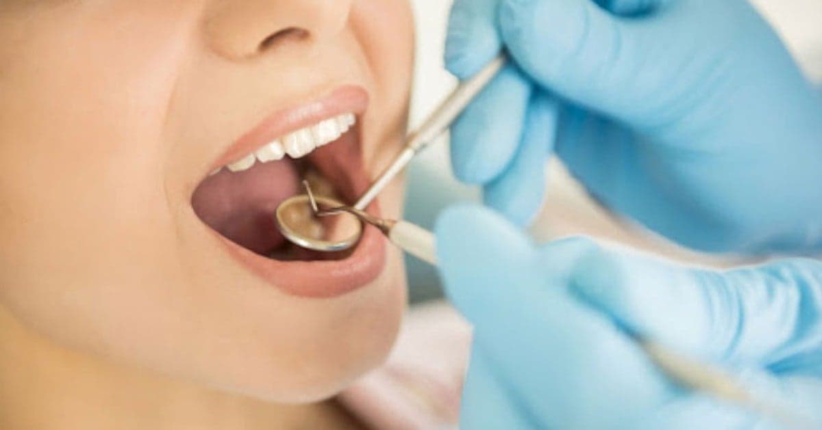 Lấy cao răng có được hưởng bảo hiểm y tế?