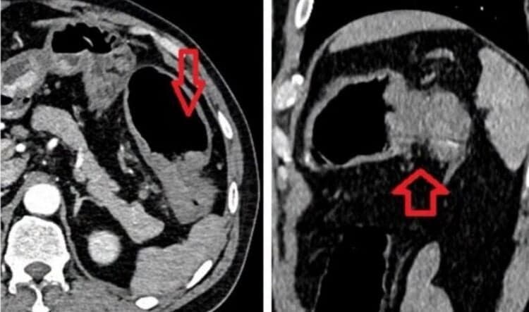 A Laotian man with intestinal obstruction underwent emergency surgery by Vietnamese doctors using a special technique.