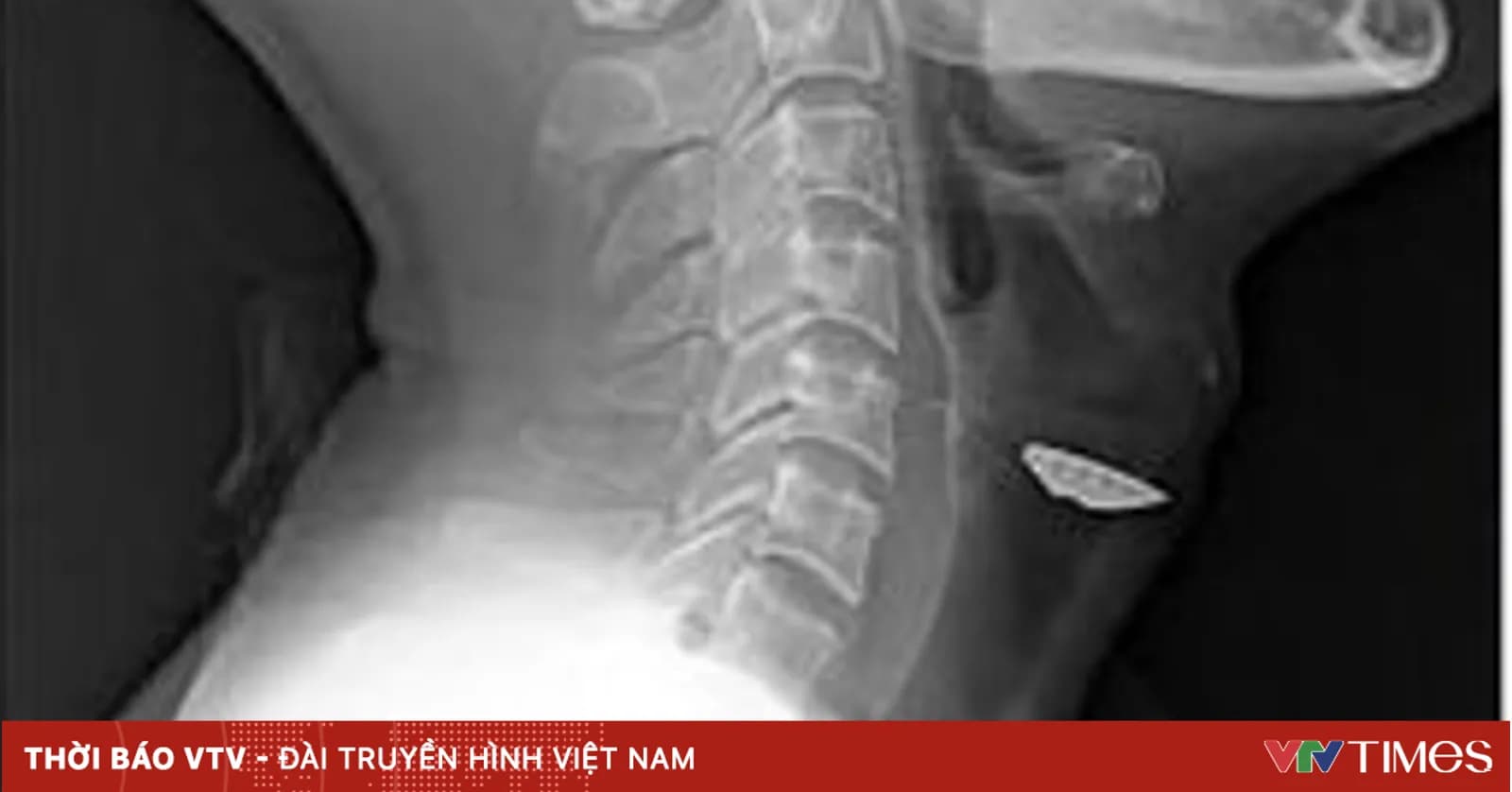 A metallic foreign object perforated the trachea after a workplace accident.